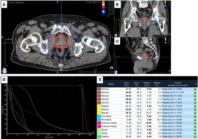 Retrospective study on the toxicity induced by stereotactic body radiotherapy: overview of the reunion experience on prostate cancer in elderly patients